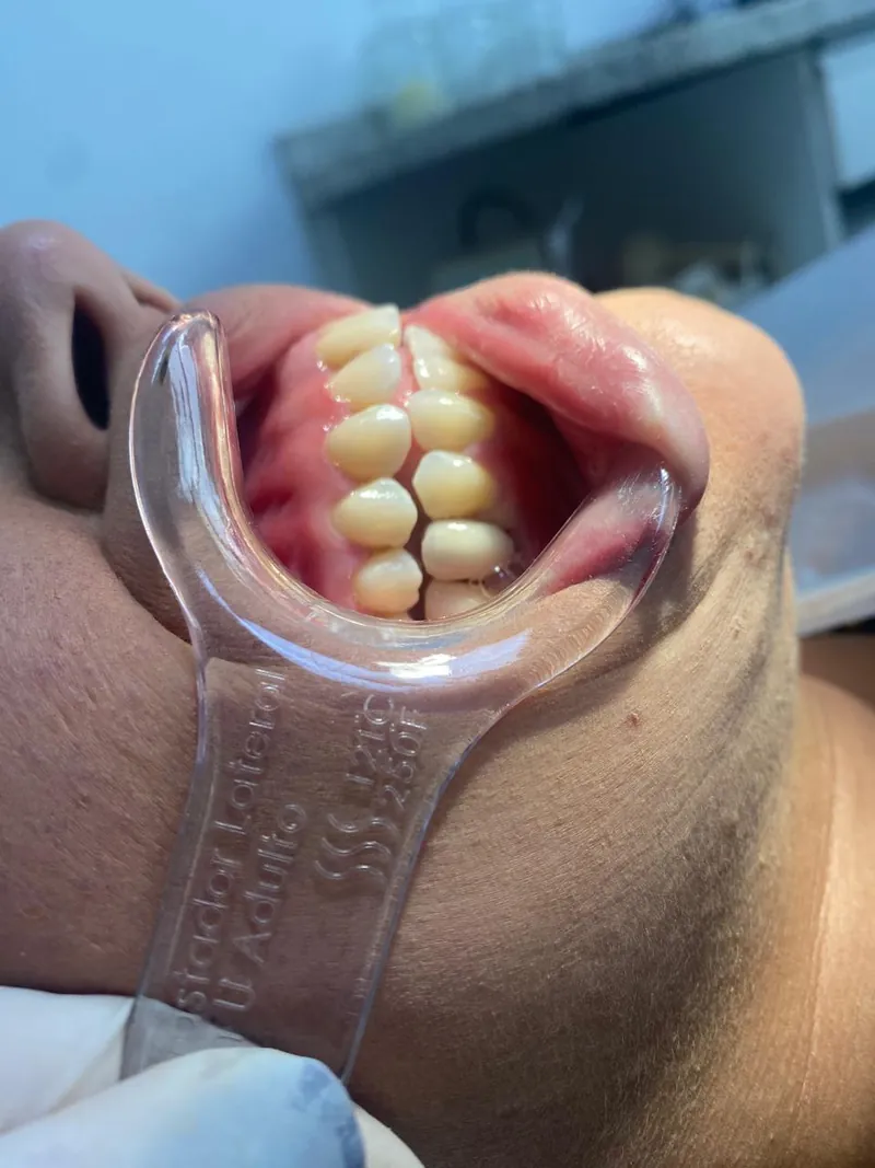 Arcada com o dente reposto por implante, depois do tratamento