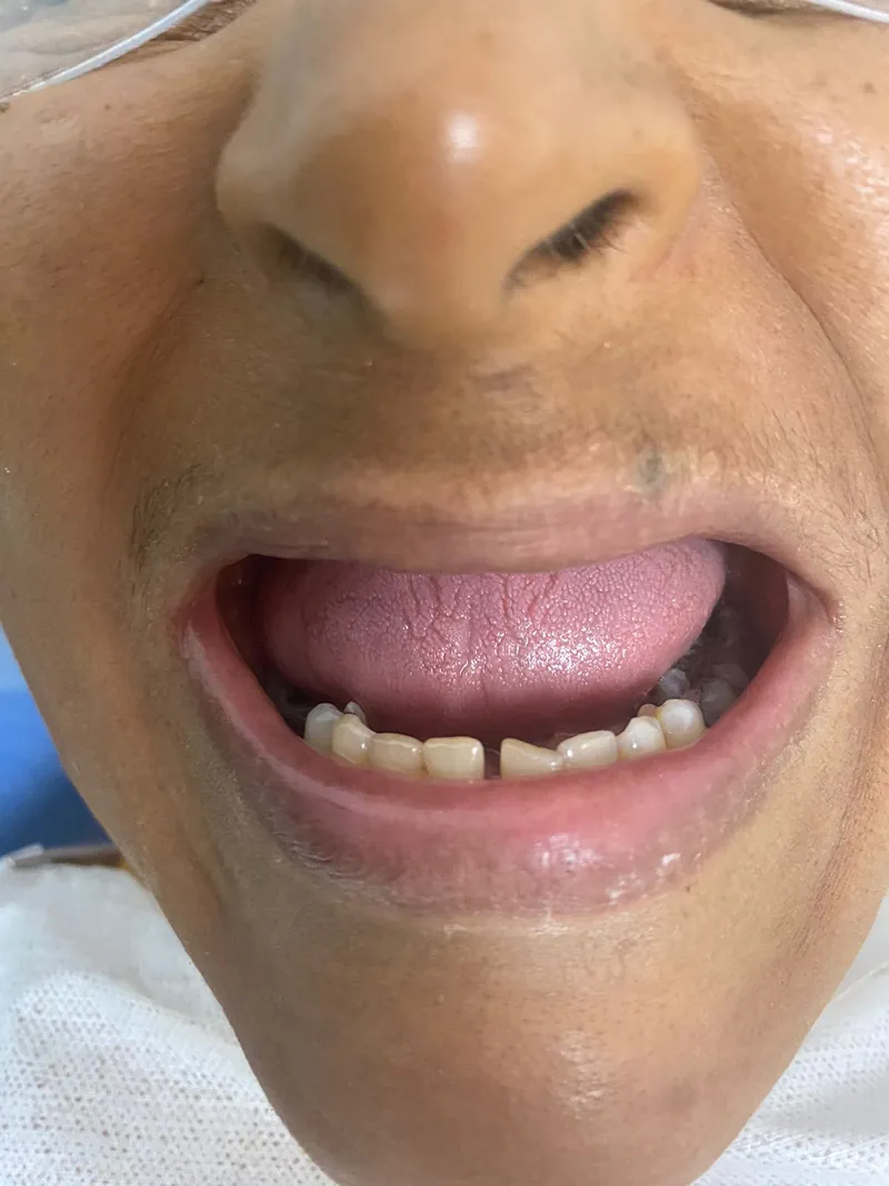 Sorriso de paciente com poucos dentes na arcada inferior, antes da prótese protocolo