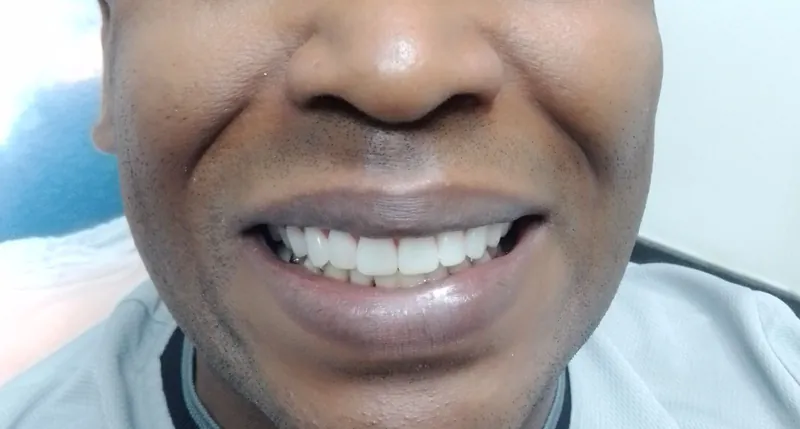 Sorriso de paciente após a prótese protocolo
