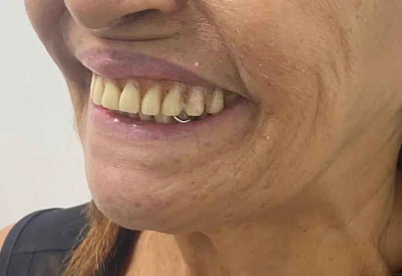 Sorriso de paciente com dentes desgastados, antes da prótese protocolo