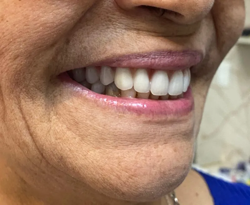 Sorriso de paciente após a prótese protocolo