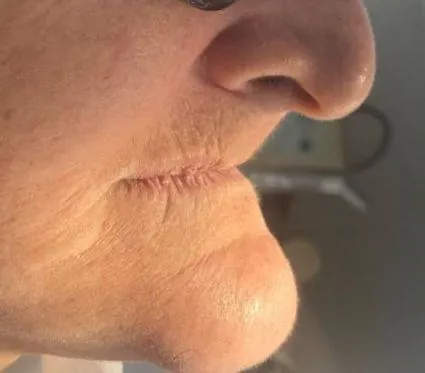 Paciente sem dentes na arcada, antes do tratamento